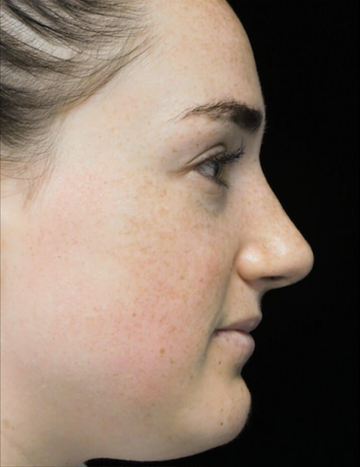 closed vs open rhinoplasty