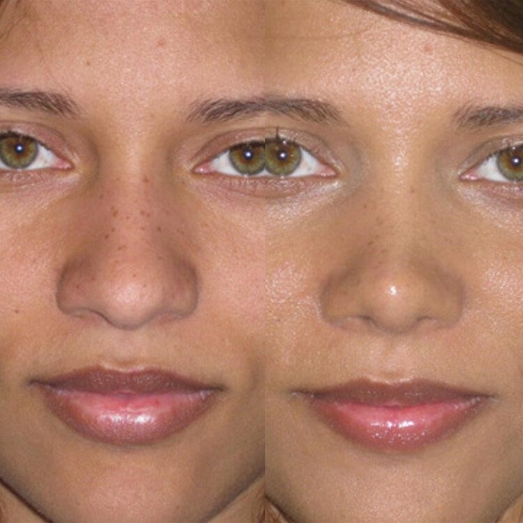 closed rhinoplasty near me