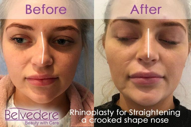 closed rhinoplasty near me